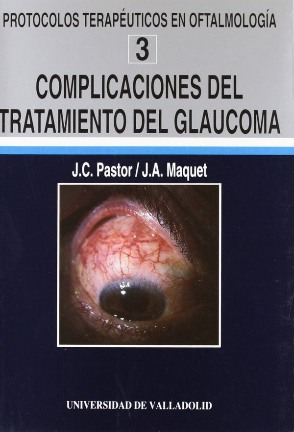 Complicaciones Del Tratamiento Del Glaucoma