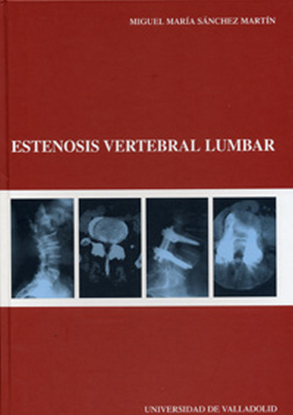 Estenosis Vertebral Lumbar