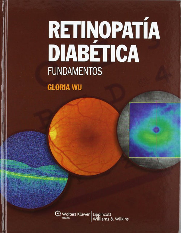 Retinopatía Diabética